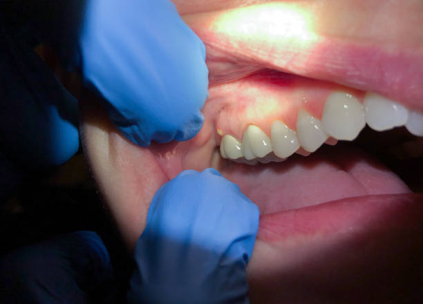 Best Emergency Treatment for Dental Infections or Abscesses in Sneads, FL